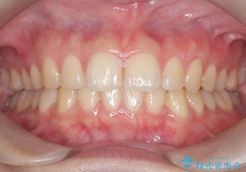 マウスピース矯正で前歯のガタツキを改善!　短期間で治療完了の症例 治療後