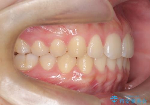 マウスピース矯正で前歯のガタツキを改善! 短期間で治療完了の治療後