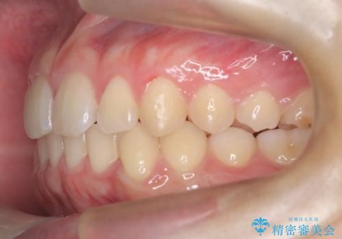 マウスピース矯正で前歯のガタツキを改善!　短期間で治療完了の治療後