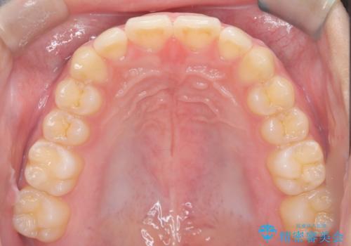 マウスピース矯正で前歯のガタツキを改善! 短期間で治療完了の治療後