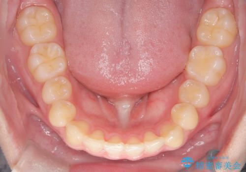 マウスピース矯正で前歯のガタツキを改善! 短期間で治療完了の治療後