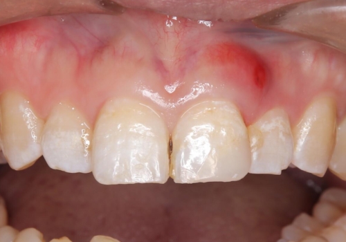 前歯が欠けた セラミッククラウンの治療中