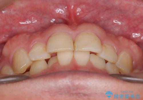 前歯が欠けた セラミッククラウンの治療中