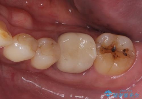 銀歯がとれた セラミックインレーで修復の治療前