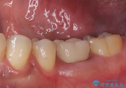 銀歯がとれた セラミックインレーで修復の治療前