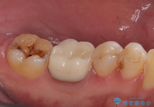 銀歯がとれた セラミックインレーで修復の治療前