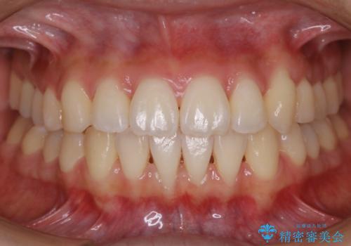 【非抜歯】マイクロインプラントで効率よく矯正を!の治療後
