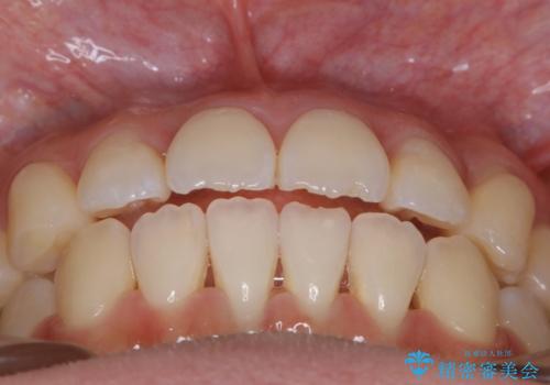 【非抜歯】マイクロインプラントで効率よく矯正を!の治療後