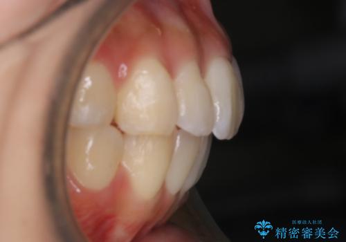 【非抜歯】マイクロインプラントで効率よく矯正を!の治療後
