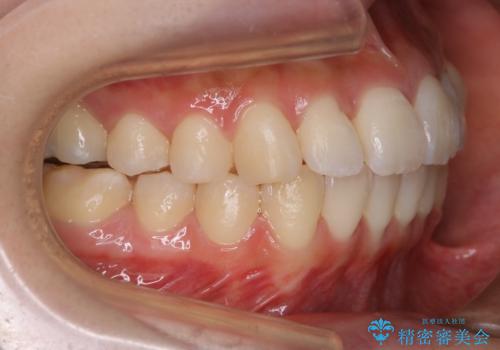 【非抜歯】マイクロインプラントで効率よく矯正を!の治療後