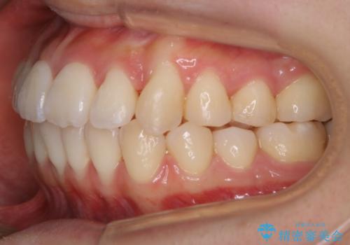 【非抜歯】マイクロインプラントで効率よく矯正を!の治療後