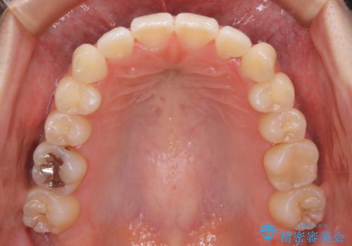 【非抜歯】マイクロインプラントで効率よく矯正を!の治療後