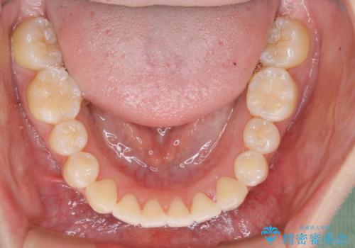 【非抜歯】マイクロインプラントで効率よく矯正を!の治療後