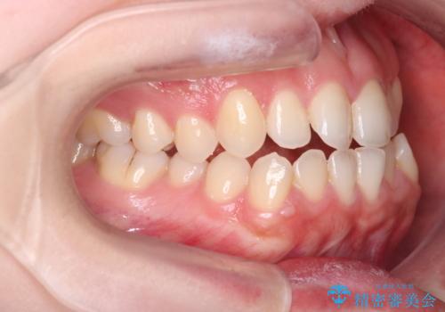 【インビザライン】オープンバイトを治したいの治療前
