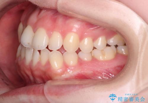 【インビザライン】オープンバイトを治したいの治療前