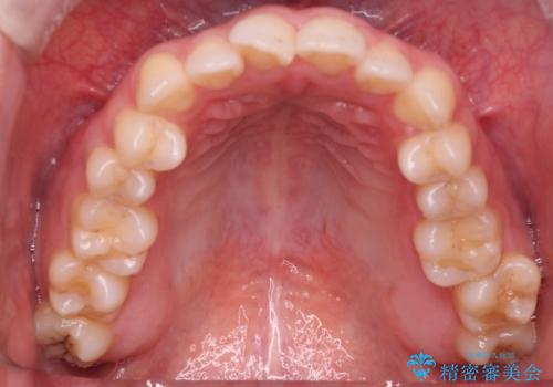 【インビザライン】オープンバイトを治したいの治療前