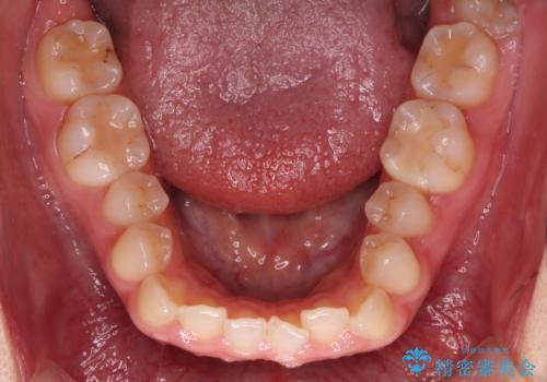 【インビザライン】オープンバイトを治したいの治療前