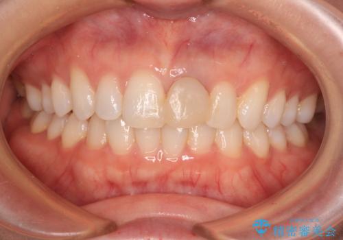 外れやすい前歯をどうにかしたい。の治療前