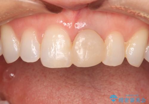 外れやすい前歯をどうにかしたい。の治療前