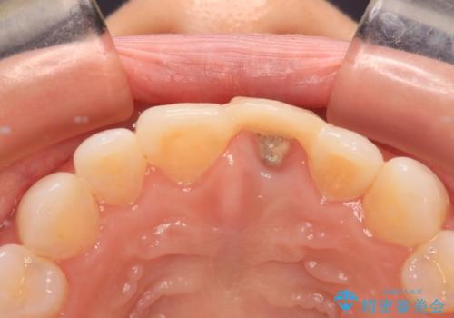 外れやすい前歯をどうにかしたい。の治療前