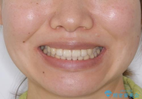 【非抜歯】マイクロインプラントで効率よく矯正を!