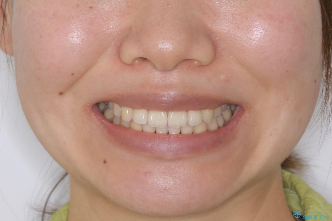 【非抜歯】マイクロインプラントで効率よく矯正を!の治療後(顔貌)