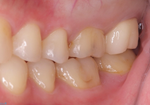 【セラミッククラウン】歯並びも綺麗になったし歯も白くしたいの治療後