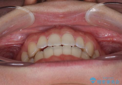 【モニター】オープンバイトをインビザライン矯正で治すの治療後