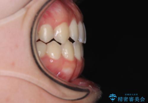 【モニター】オープンバイトをインビザライン矯正で治すの治療後