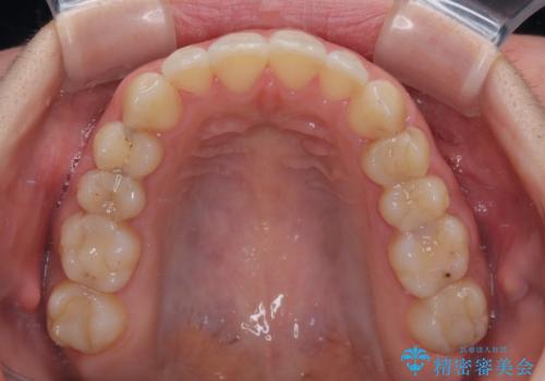 【モニター】オープンバイトをインビザライン矯正で治すの治療後