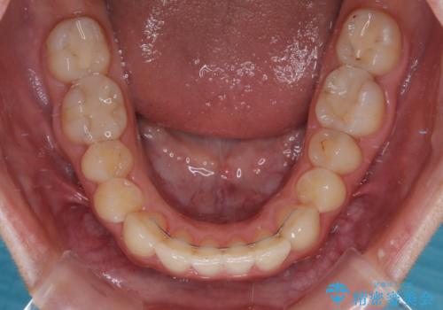 【モニター】オープンバイトをインビザライン矯正で治すの治療後