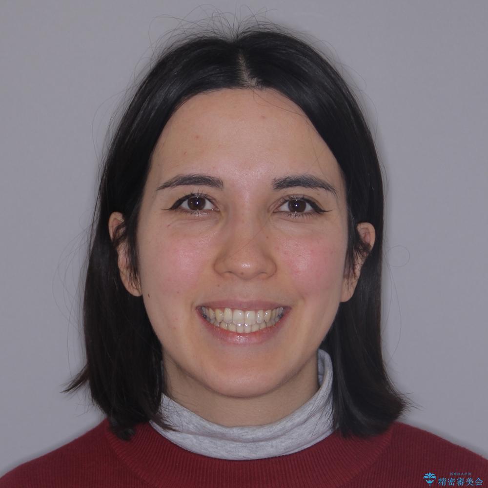 【モニター】オープンバイトをインビザライン矯正で治すの治療後(顔貌)