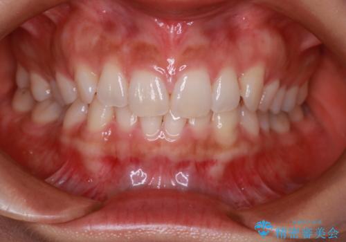 【インビザライン】前歯のねじれを治したいの治療前