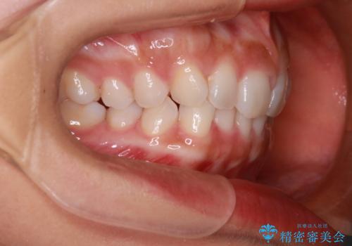 【インビザライン】前歯のねじれを治したいの治療前