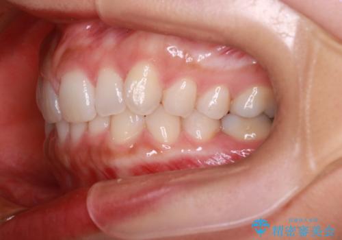 【インビザライン】前歯のねじれを治したいの治療前