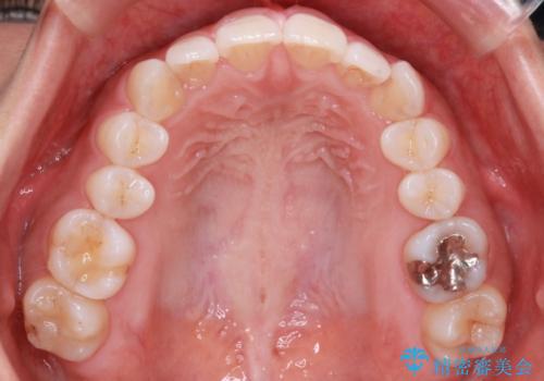 【インビザライン】前歯のねじれを治したいの治療前