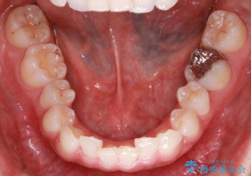 【インビザライン】前歯のねじれを治したいの治療前