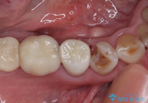 咬合力で欠けてしまった歯 丈夫なセラミッククラウンでの補綴治療の症例 治療前