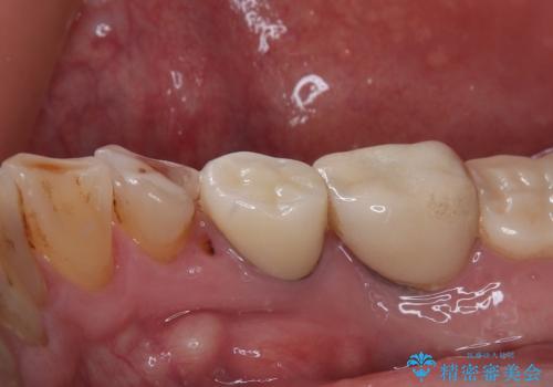 咬合力で欠けてしまった歯 丈夫なセラミッククラウンでの補綴治療の治療前