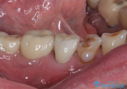 咬合力で欠けてしまった歯 丈夫なセラミッククラウンでの補綴治療の治療前