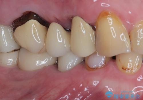 咬合力で欠けてしまった歯 丈夫なセラミッククラウンでの補綴治療の治療前