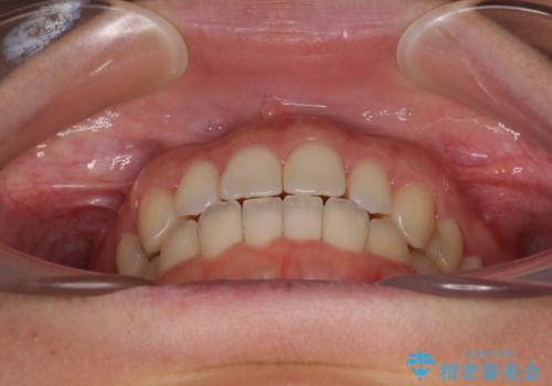 【モニター】オープンバイトをインビザライン矯正で治すの治療中