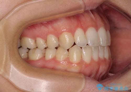 【モニター】オープンバイトをインビザライン矯正で治すの治療中