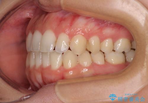 【モニター】オープンバイトをインビザライン矯正で治すの治療中