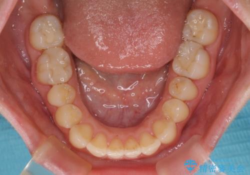【モニター】オープンバイトをインビザライン矯正で治すの治療中