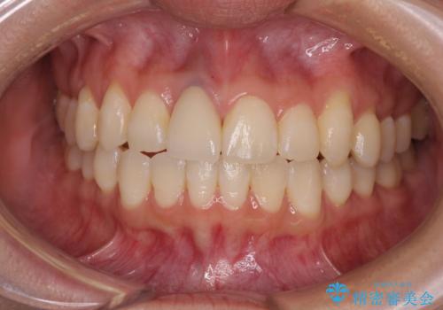 前歯をきれいなセラミックにしたい。の症例 治療後