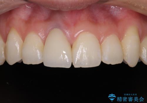 前歯をきれいなセラミックにしたい。の治療後
