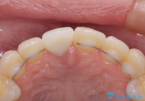 前歯をきれいなセラミックにしたい。の治療後