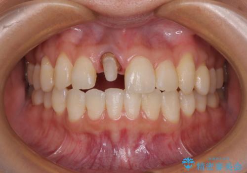 前歯をきれいなセラミックにしたい。の治療中