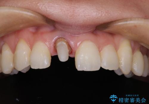 前歯をきれいなセラミックにしたい。の治療中